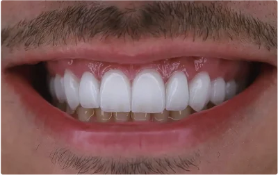 lentes de contato